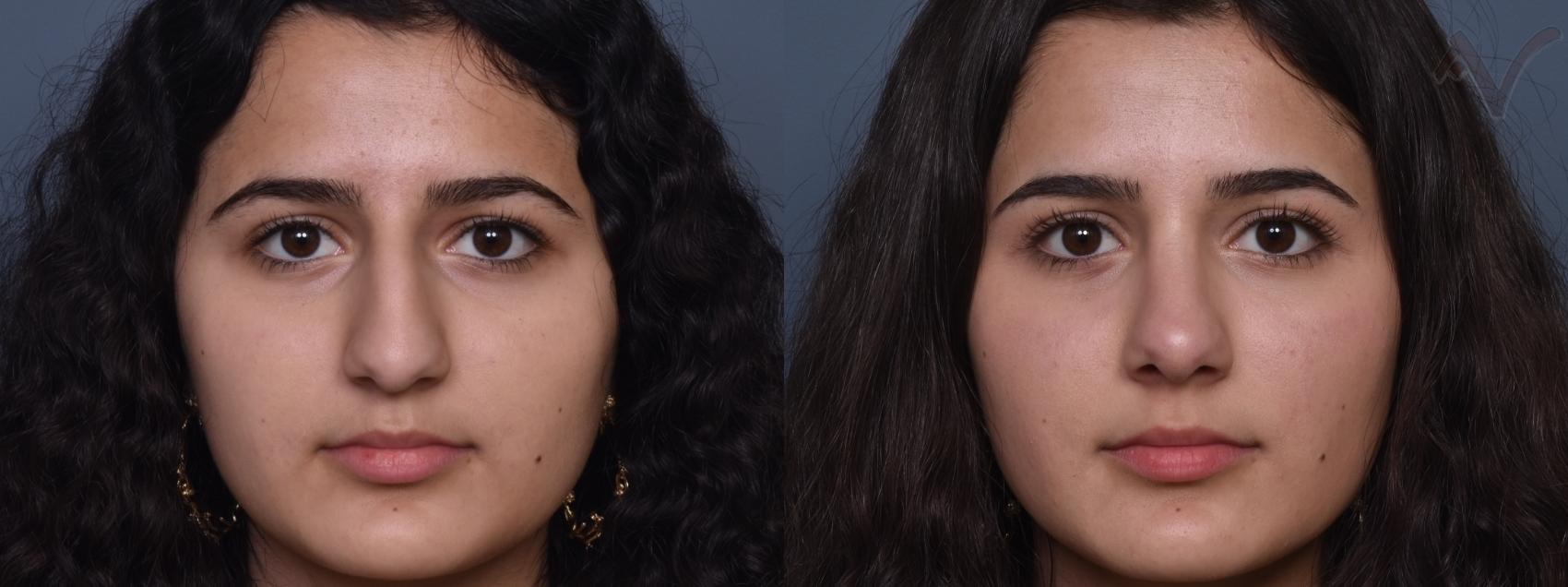 Before & After Rhinoplasty Case 427 Front View in Los Angeles, CA