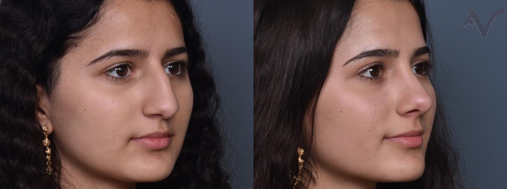 Before & After Rhinoplasty Case 427 Right Oblique View in Los Angeles, CA