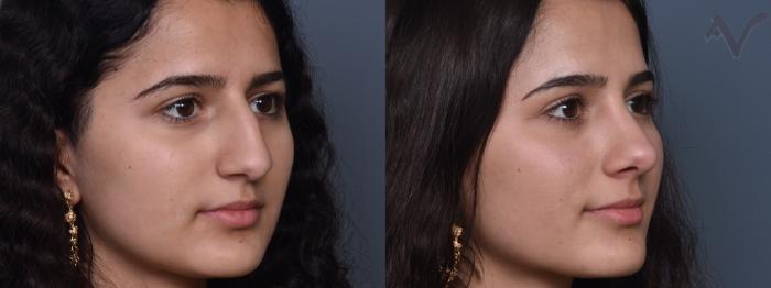 Before & After Rhinoplasty Case 427 Right Oblique View in Los Angeles, CA