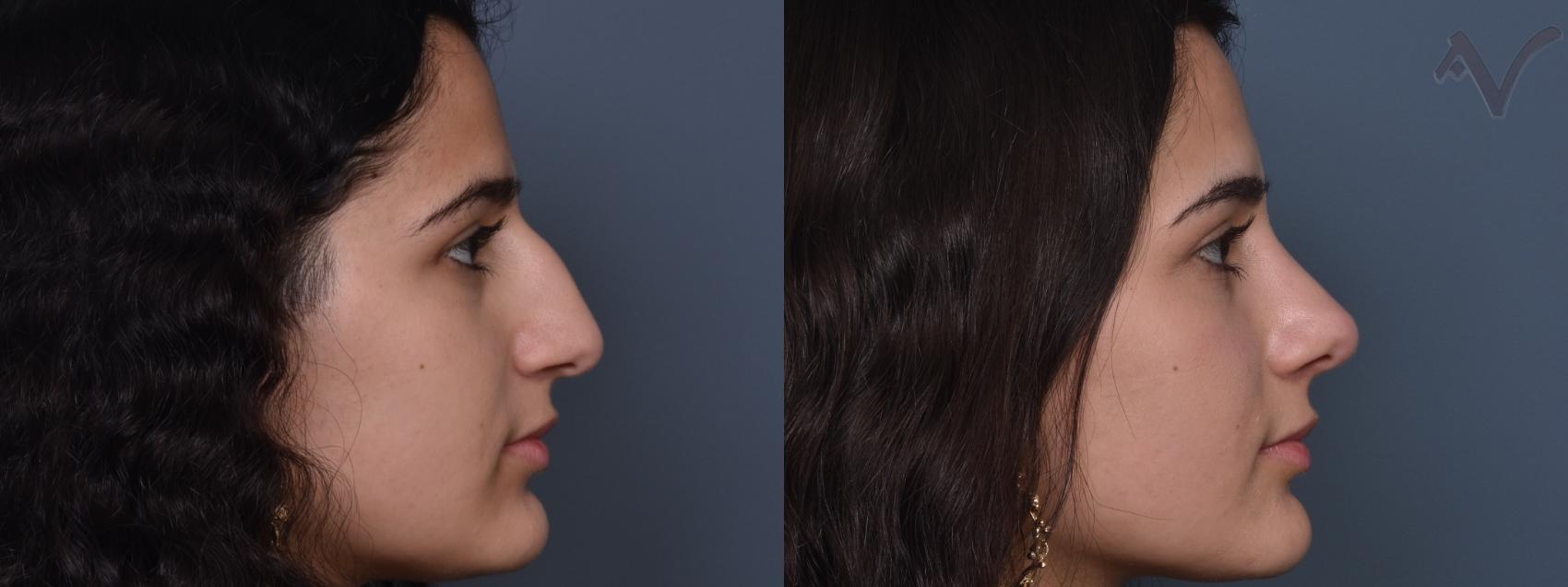Before & After Rhinoplasty Case 427 Right Side View in Los Angeles, CA