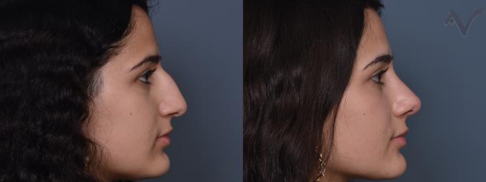 Before & After Rhinoplasty Case 427 Right Side View in Los Angeles, CA