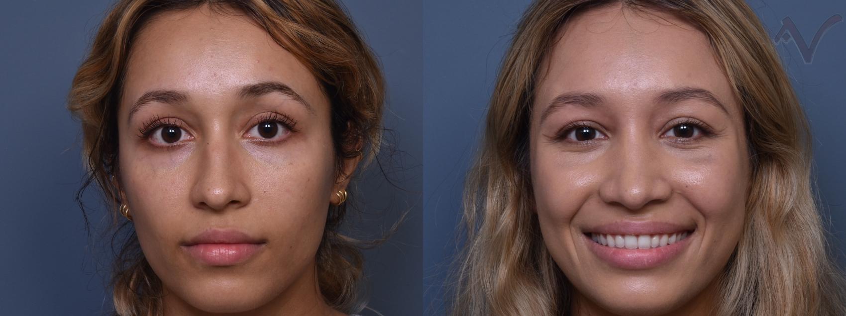 Before & After Rhinoplasty Case 428 Front View in Los Angeles, CA