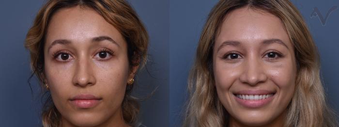 Before & After Rhinoplasty Case 428 Front View in Los Angeles, CA