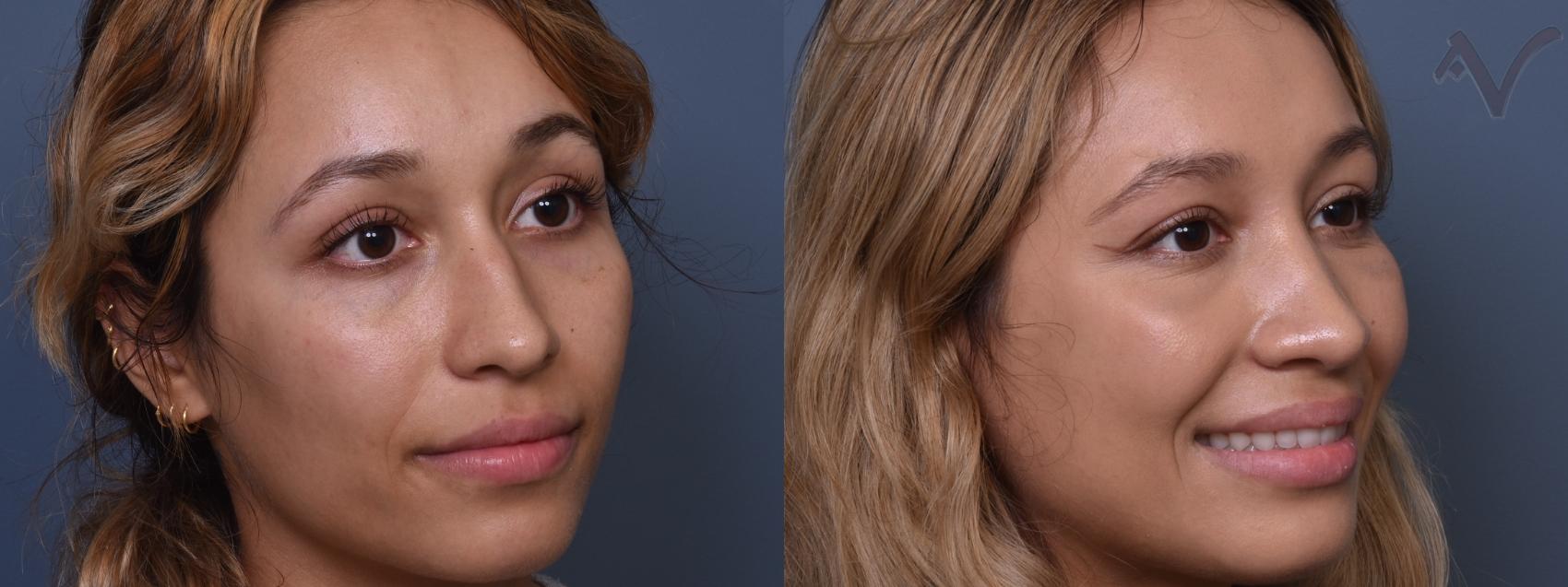 Before & After Rhinoplasty Case 428 Right Oblique View in Los Angeles, CA