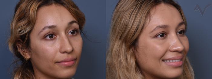 Before & After Rhinoplasty Case 428 Right Oblique View in Los Angeles, CA