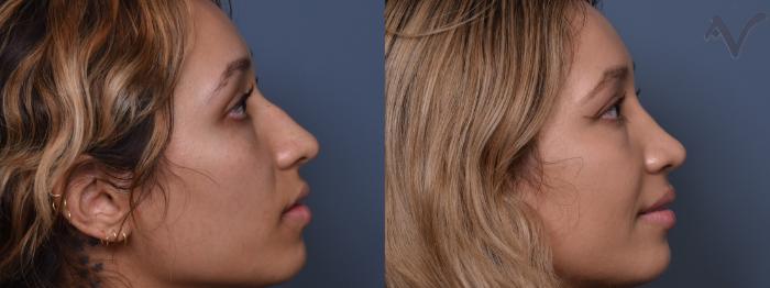 Before & After Rhinoplasty Case 428 Right Side View in Los Angeles, CA