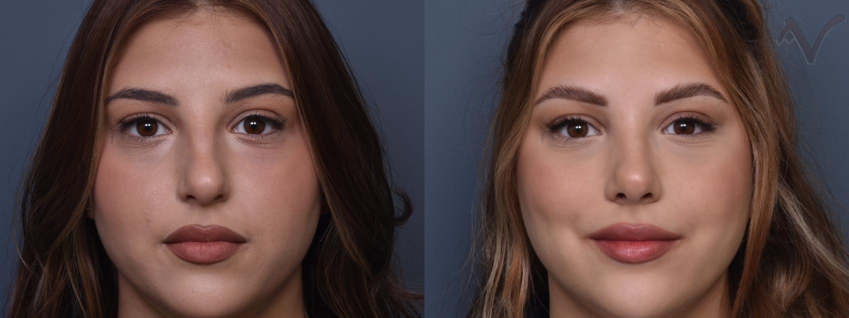 Before & After Rhinoplasty Case 429 Front View in Los Angeles, CA