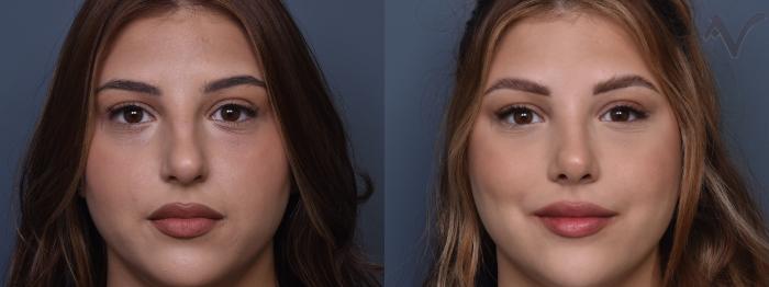 Before & After Rhinoplasty Case 429 Front View in Los Angeles, CA