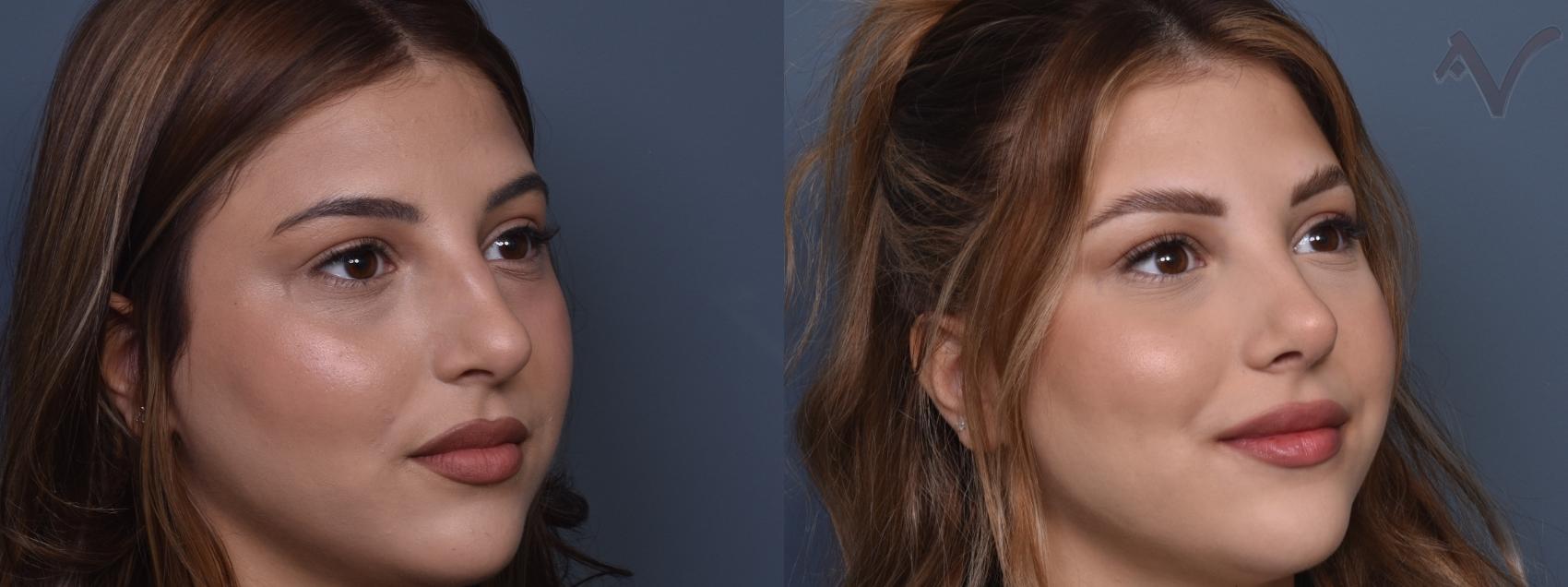 Before & After Rhinoplasty Case 429 Right Oblique View in Los Angeles, CA