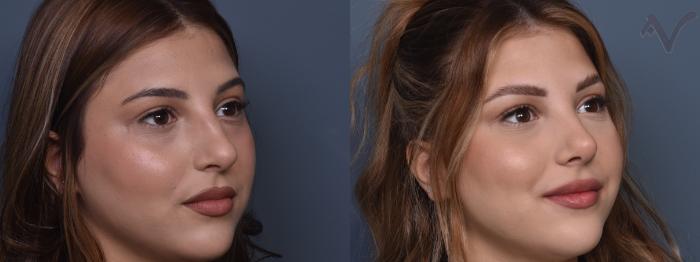 Before & After Rhinoplasty Case 429 Right Oblique View in Los Angeles, CA