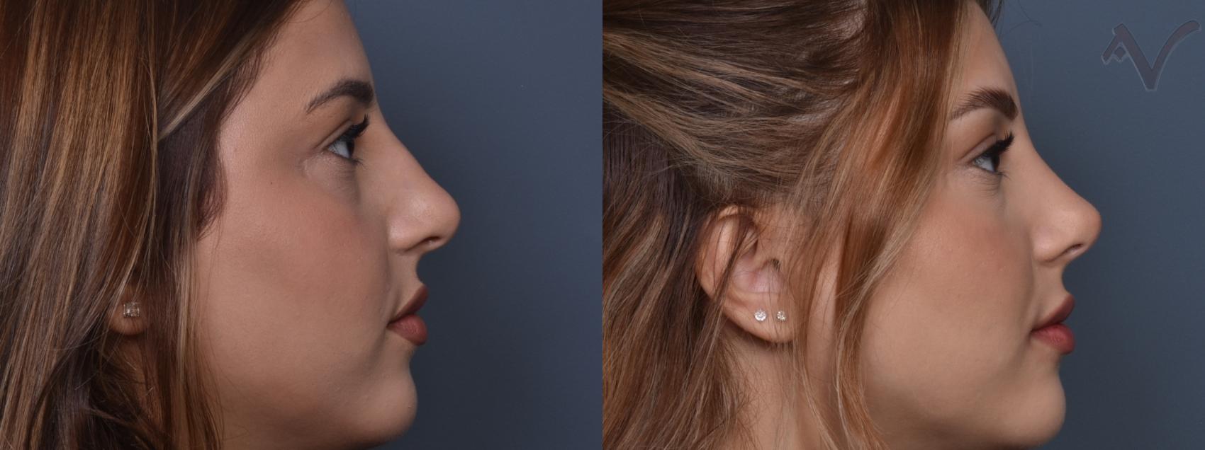 Before & After Rhinoplasty Case 429 Right Side View in Los Angeles, CA