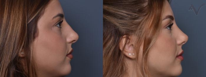 Before & After Rhinoplasty Case 429 Right Side View in Los Angeles, CA