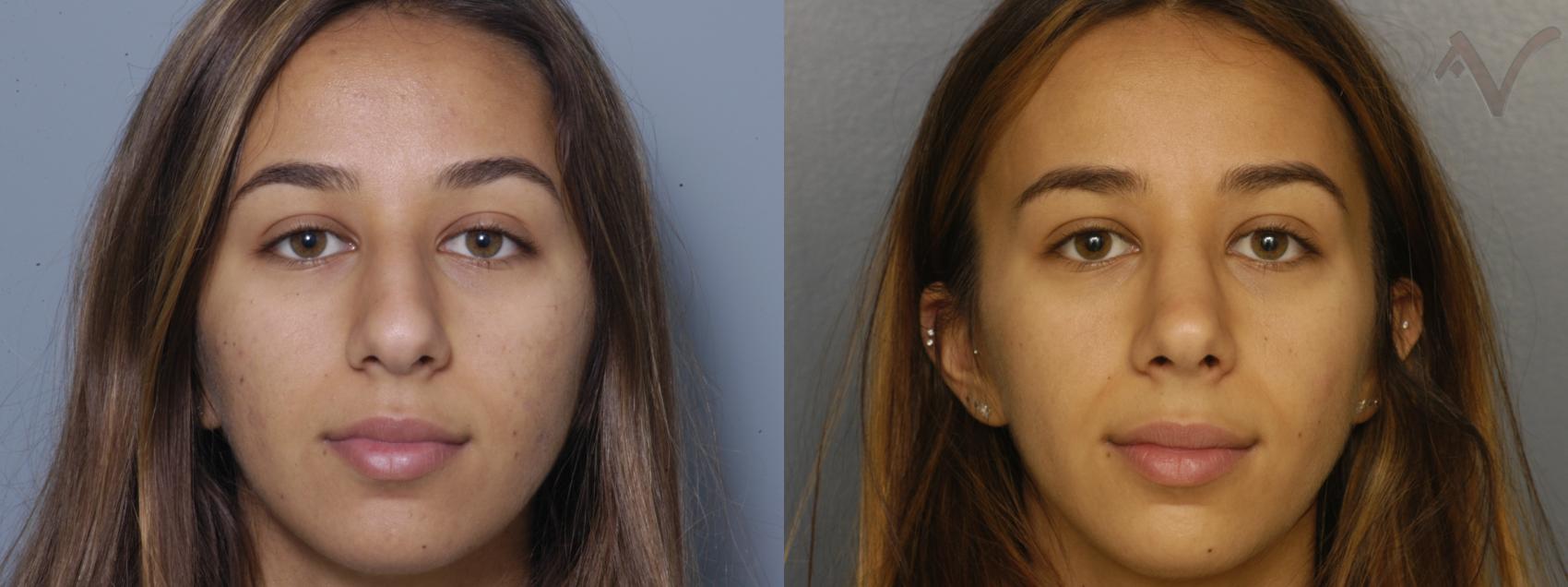 Before & After Rhinoplasty Case 430 Front View in Los Angeles, CA