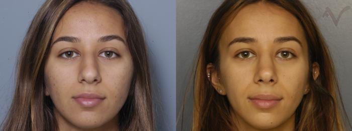 Before & After Rhinoplasty Case 430 Front View in Los Angeles, CA