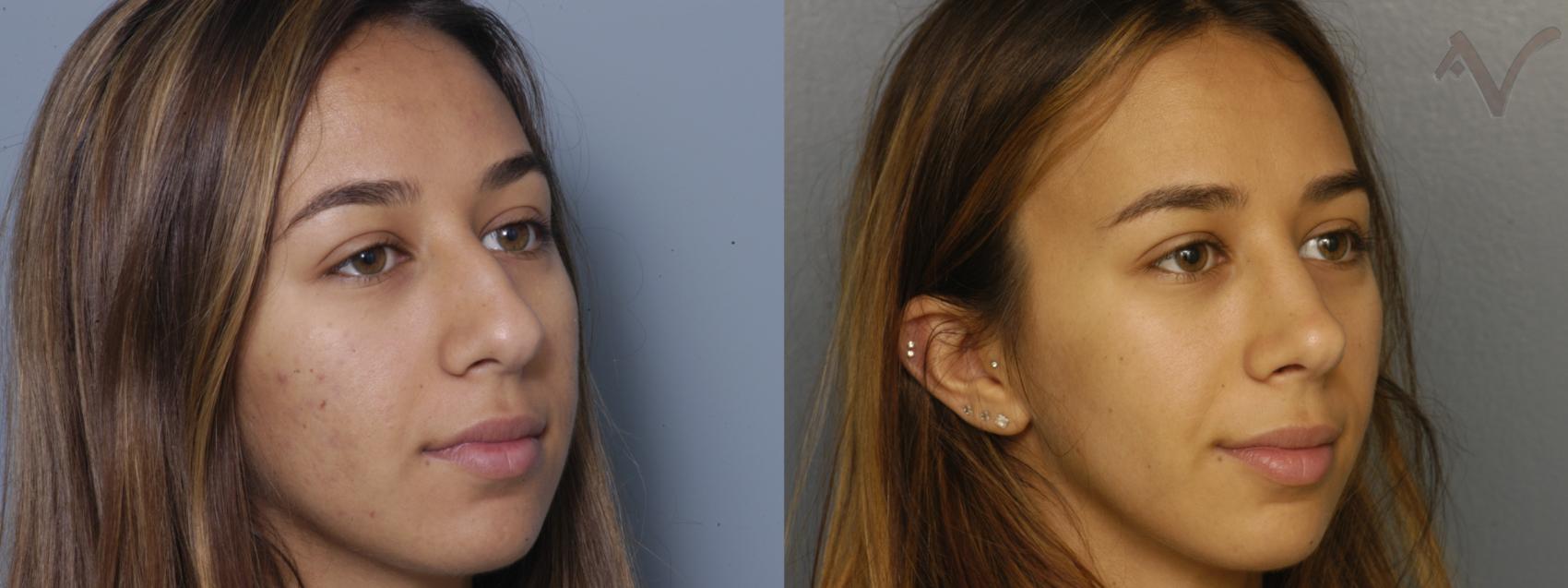 Before & After Rhinoplasty Case 430 Right Oblique View in Los Angeles, CA