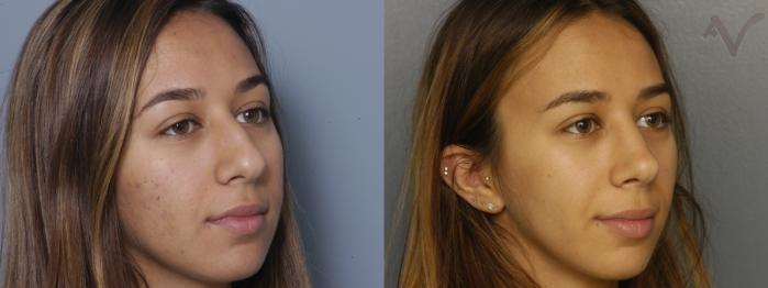 Before & After Rhinoplasty Case 430 Right Oblique View in Los Angeles, CA
