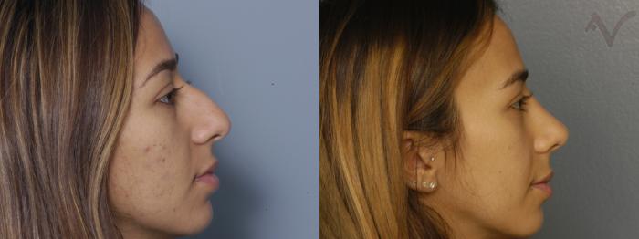 Before & After Rhinoplasty Case 430 Right Side View in Los Angeles, CA