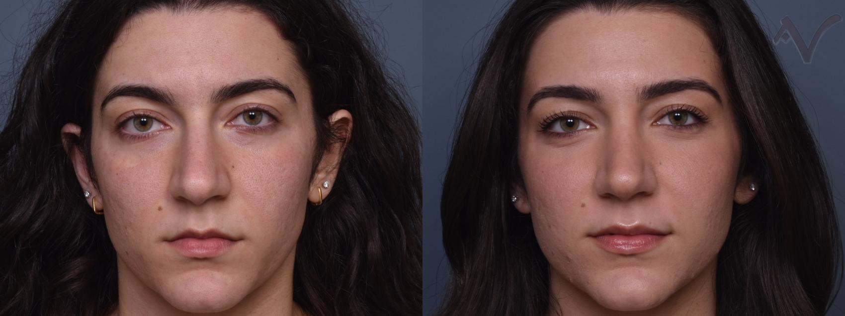 Before & After Rhinoplasty Case 431 Front View in Los Angeles, CA