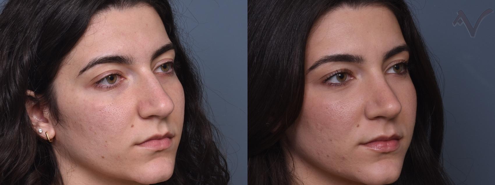 Before & After Rhinoplasty Case 431 Right Oblique View in Los Angeles, CA