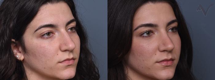 Before & After Rhinoplasty Case 431 Right Oblique View in Los Angeles, CA