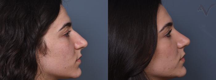 Before & After Rhinoplasty Case 431 Right Side View in Los Angeles, CA