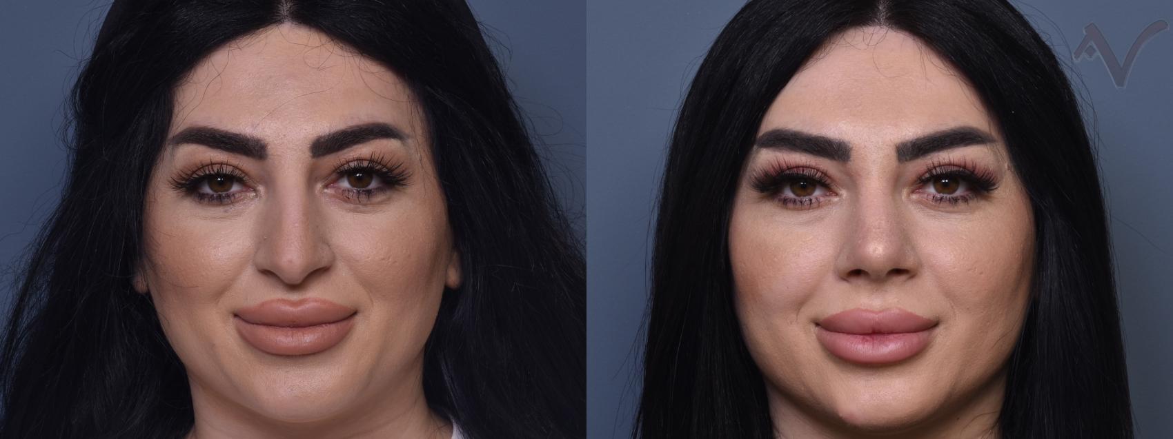 Before & After Rhinoplasty Case 432 Front View in Los Angeles, CA