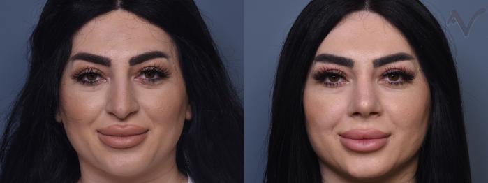 Before & After Rhinoplasty Case 432 Front View in Los Angeles, CA