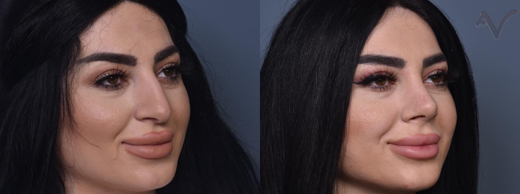 Before & After Rhinoplasty Case 432 Right Oblique View in Los Angeles, CA