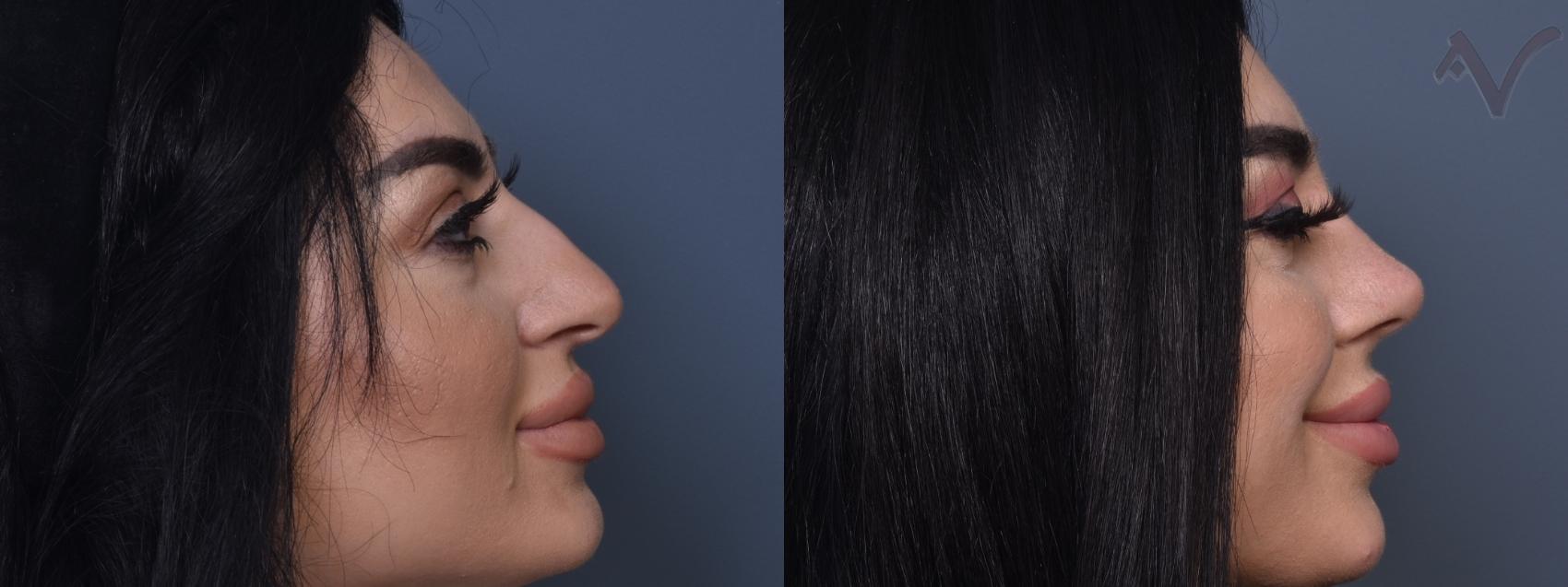 Before & After Rhinoplasty Case 432 Right Side View in Los Angeles, CA