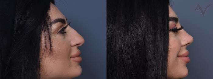 Before & After Rhinoplasty Case 432 Right Side View in Los Angeles, CA