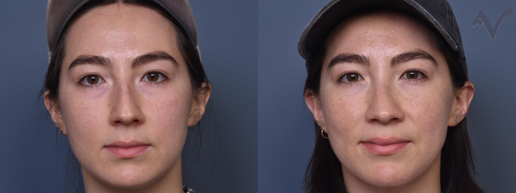 Before & After Rhinoplasty Case 433 Front View in Los Angeles, CA
