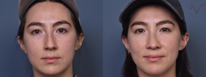 Before & After Rhinoplasty Case 433 Front View in Los Angeles, CA