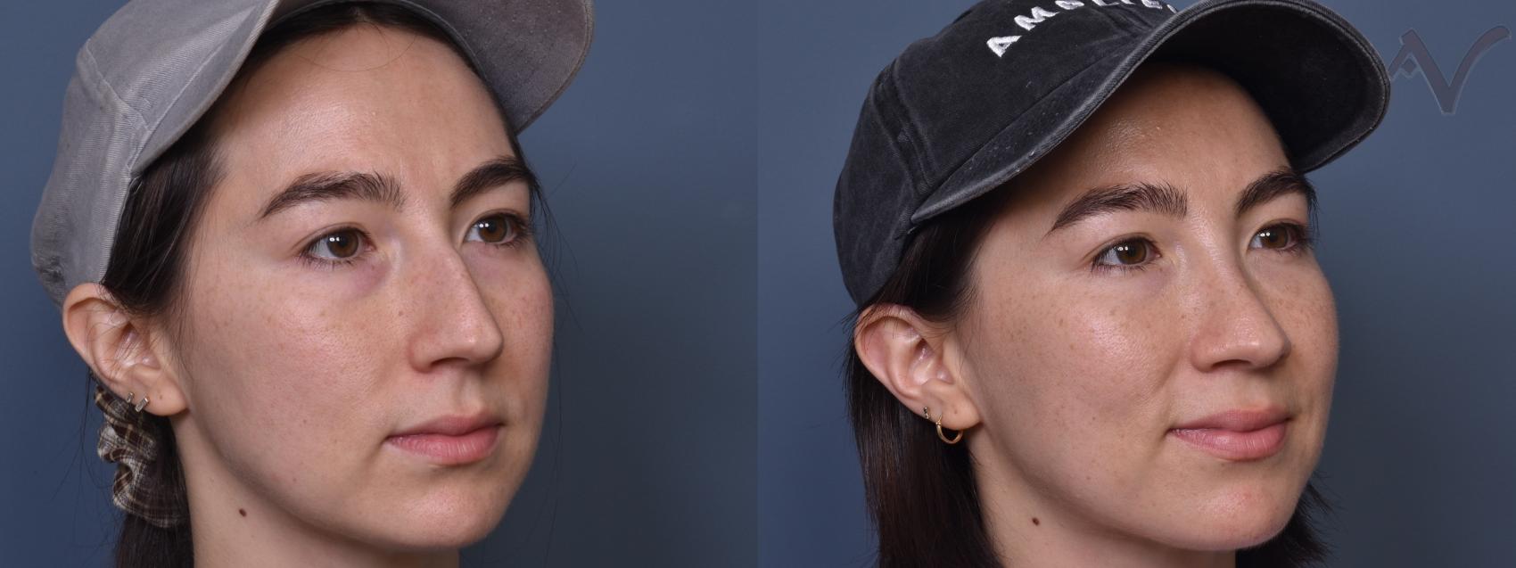 Before & After Rhinoplasty Case 433 Right Oblique View in Los Angeles, CA