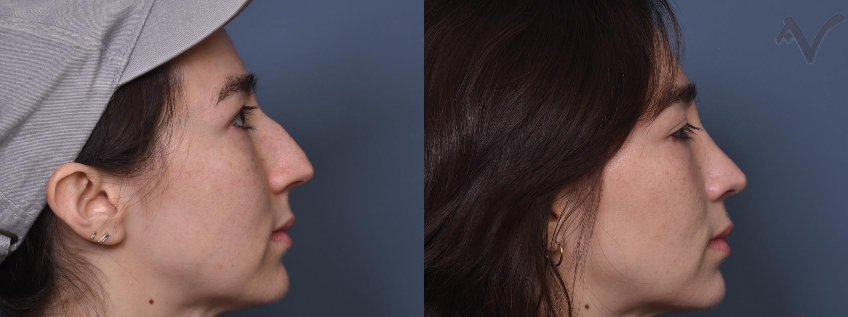 Before & After Rhinoplasty Case 433 Right Side View in Los Angeles, CA
