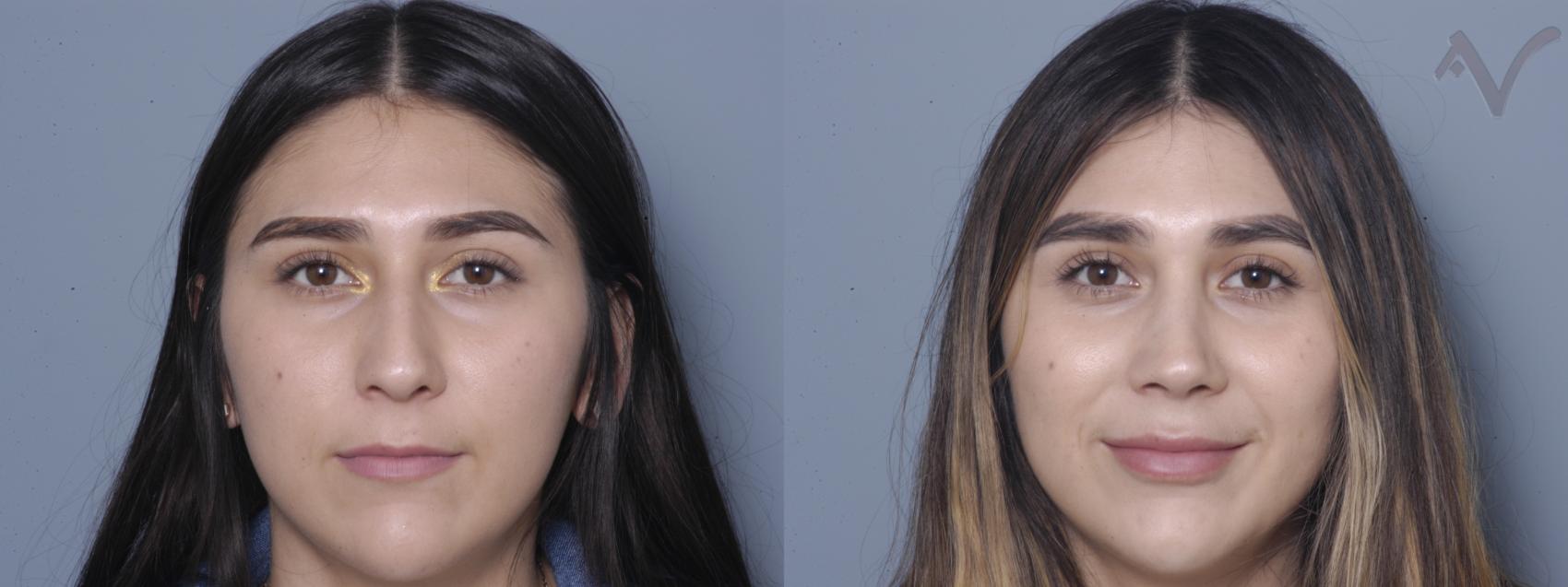 Before & After Rhinoplasty Case 6 Front View in Los Angeles, CA