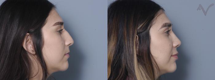 Before & After Rhinoplasty Case 6 Right Side View in Los Angeles, CA