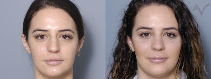 Before & After Rhinoplasty Case 7 Front View in Los Angeles, CA