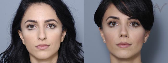 Before & After Rhinoplasty Case 8 Front View in Los Angeles, CA