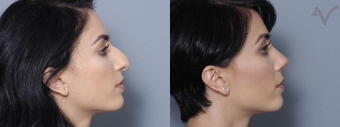 Before & After Rhinoplasty Case 8 Right Side View in Los Angeles, CA