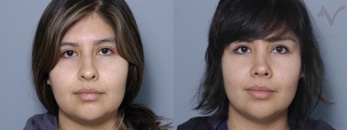 Before & After Rhinoplasty Case 81 Front View in Los Angeles, CA