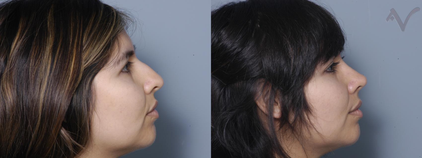 Before & After Rhinoplasty Case 81 Right Side View in Burbank, CA