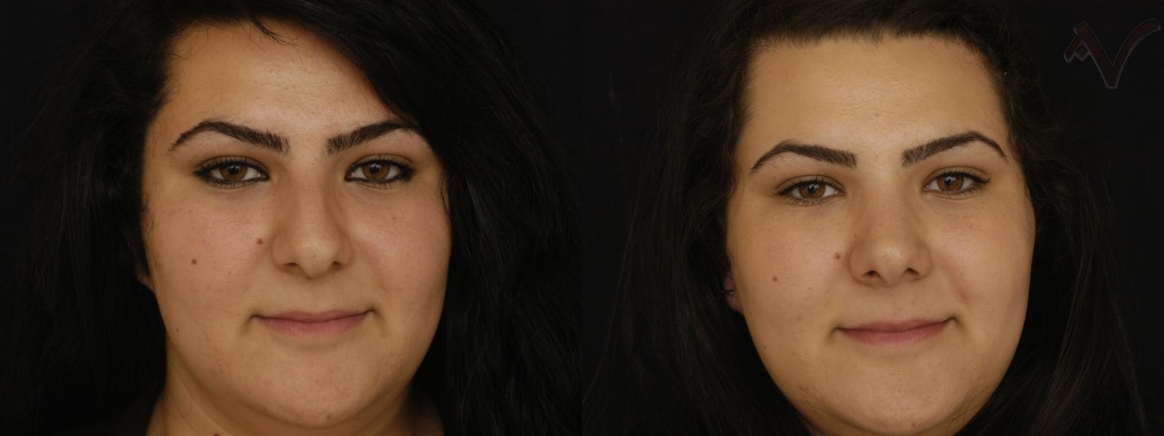 Before & After Rhinoplasty Case 82 Front View in Burbank, CA