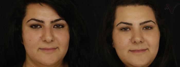 Before & After Rhinoplasty Case 82 Front View in Los Angeles, CA