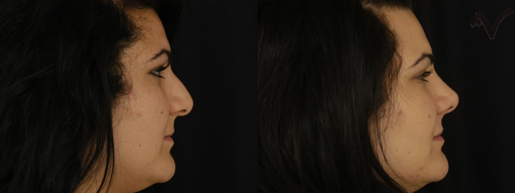 Before & After Rhinoplasty Case 82 Right Side View in Los Angeles, CA