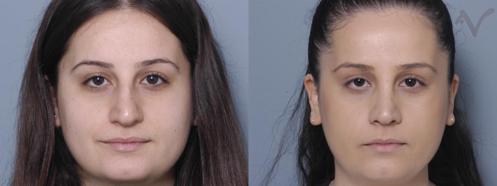 Before & After Rhinoplasty Case 83 Front View in Burbank, CA