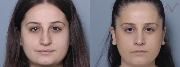 Before & After Rhinoplasty Case 83 Front View in Los Angeles, CA