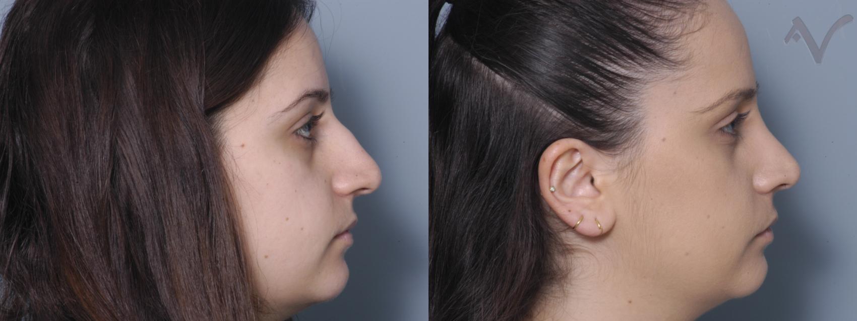 Before & After Rhinoplasty Case 83 Right Side View in Los Angeles, CA