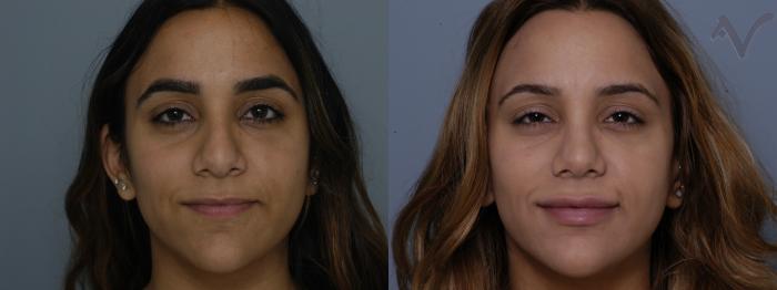 Before & After Rhinoplasty Case 84 Front View in Los Angeles, CA