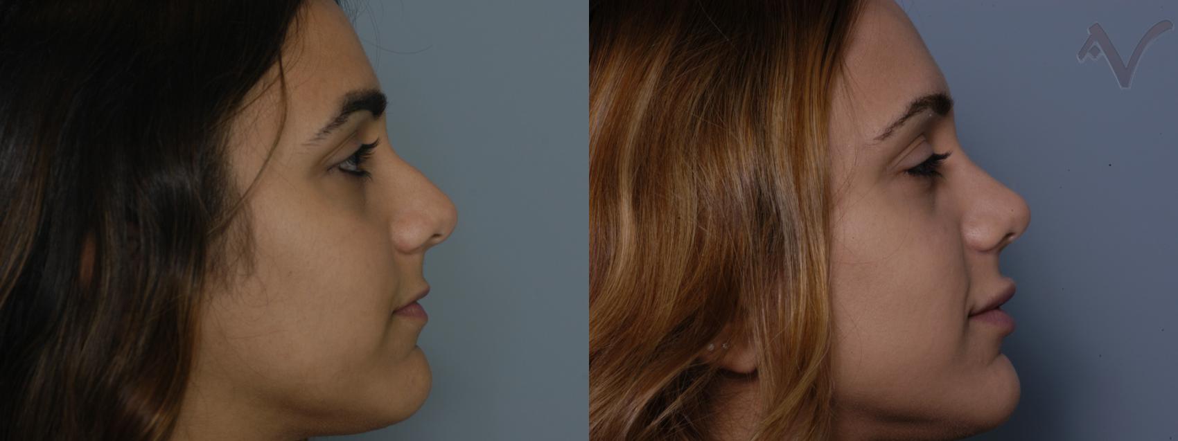 Before & After Rhinoplasty Case 84 Right Side View in Los Angeles, CA