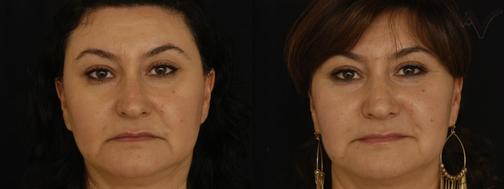Before & After Rhinoplasty Case 85 Front View in Burbank, CA